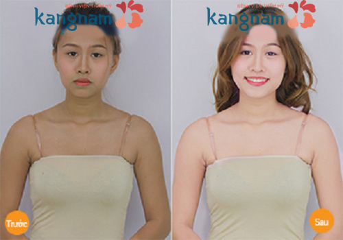 Hình ảnh khách hàng sau khi tắm trắng toàn thân tại Kangnam
